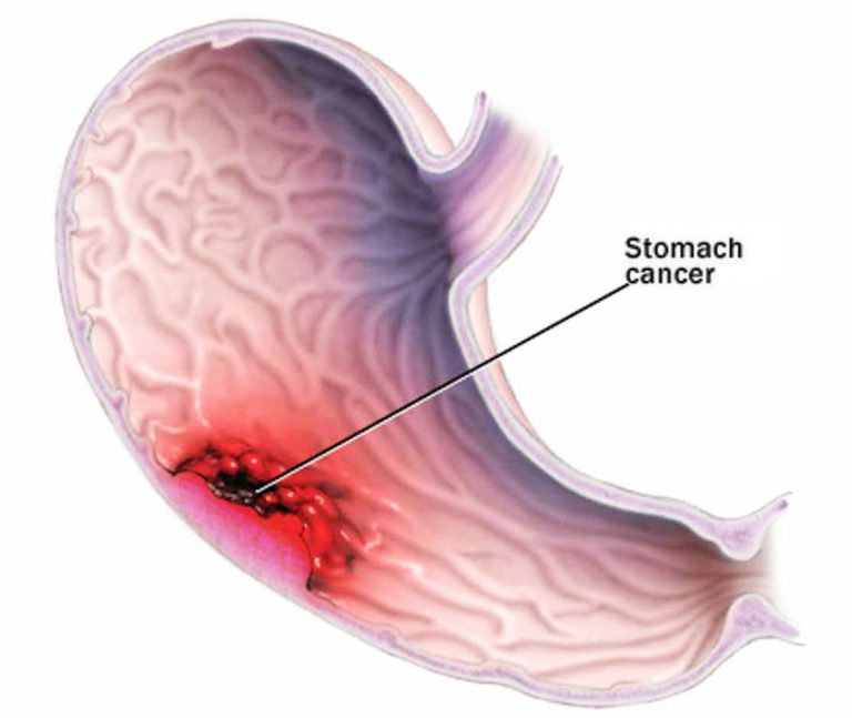 Hereditary diffuse gastric cancer (HDGC) CDH1 gene